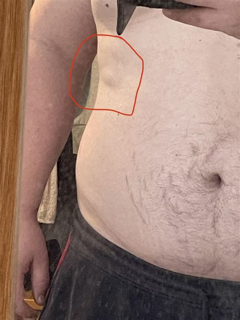 Is this a lipoma? : r/Lipoma