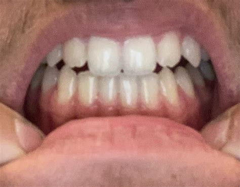 Are my receding gums on my lower canines something I should be worried ...