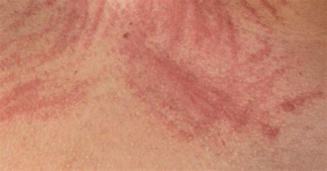 Skin Scratch