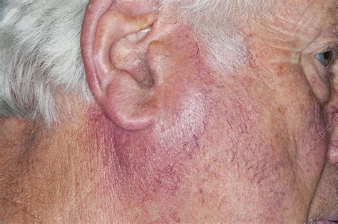 Parotid Gland Parotitis