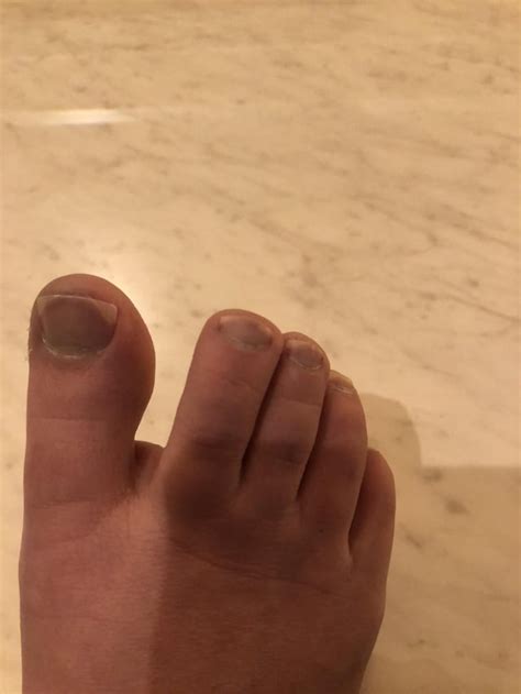 Raynauds in feet and hands. : r/Raynauds
