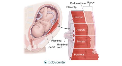 Symptômes, traitement et facteurs de risque du placenta accreta ...