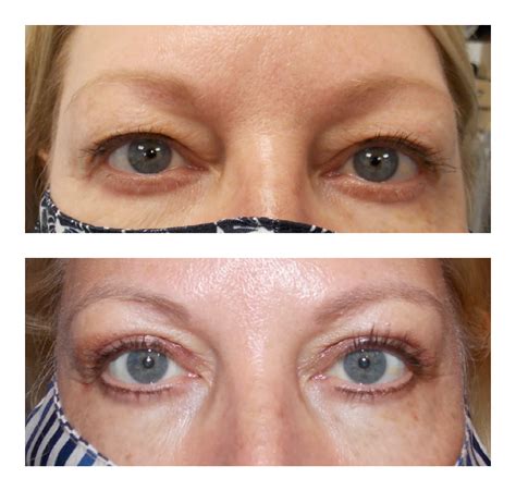 Blepharoplasty — LNC Oculoplastics