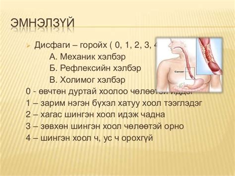 Улаан хоолойн хавдар