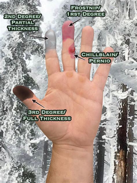 Frostbite Hands Frostbite Fingers Hi Res Stock Photography And Images