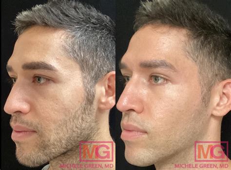Sculptra vs. Radiesse, Choosing & Comparing Fillers - Dr. Michele Green ...