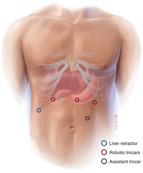 Robotic heller myotomy - Clinical Tree