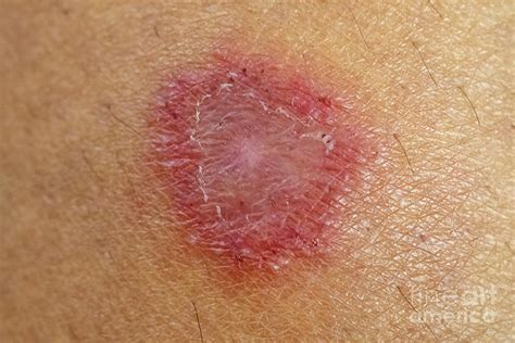 Fungal Skin Infection Photograph by Choksawatdikorn / Science Photo ...