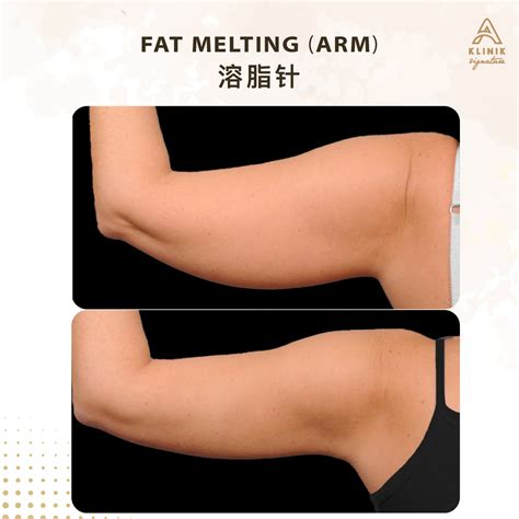 Melt Fat In Malta: Your Guide To Injectable Treatments