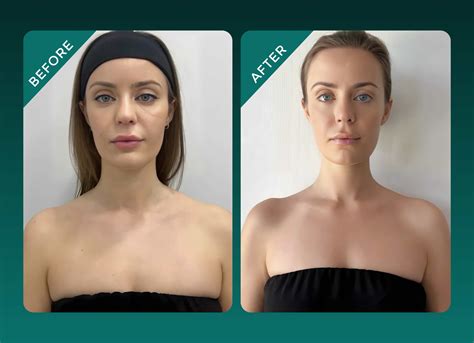 Upkeep | Trap Botox: Your Guide To The Latest MedSpa Trend