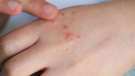 The Man Applying Psoriasis Relief Cream, Medical and Health Care ...