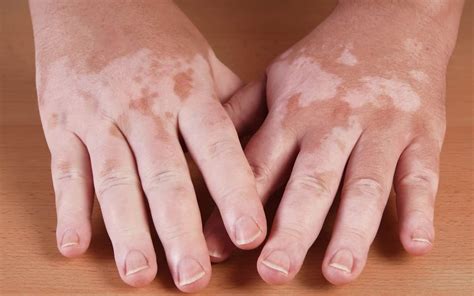 Бели петна по кожата: възможни причини и лечение - AromaMag