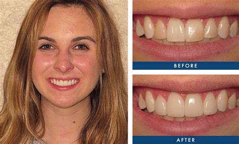 dental inlays  onlays smile design dentistry