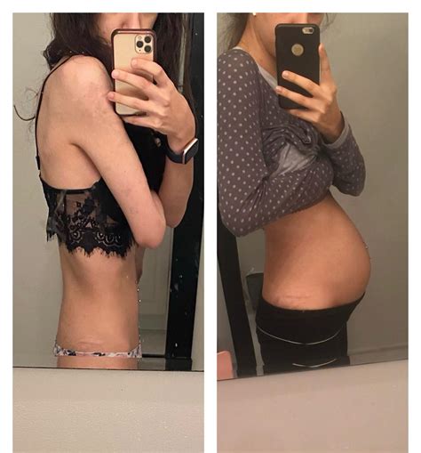 Extreme Bloating In Stomach Drawn Woman No Longer 'embarassed' After