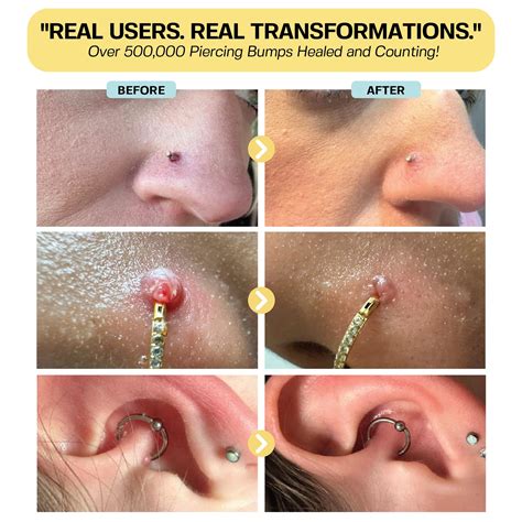 Snapklik.com : Piercing Bump Solution & Keloid Bump Removal Soothing