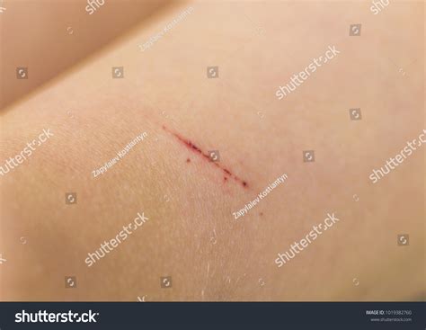 64,632 Skin Scratches Images, Stock Photos & Vectors | Shutterstock