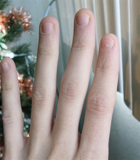 Before and After my Onycholysis, and my First Mani after my Nail Healed