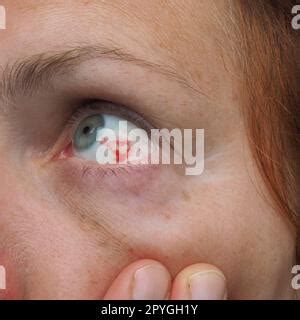 Subconjunctival hemorrhage or subconjunctival bleeding, hyposhagmus ...