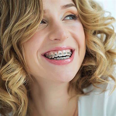 modern braces    long  saint orthodontics