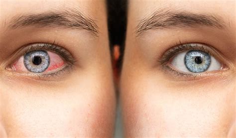 cornea  conjunctiva dry eye medical optics