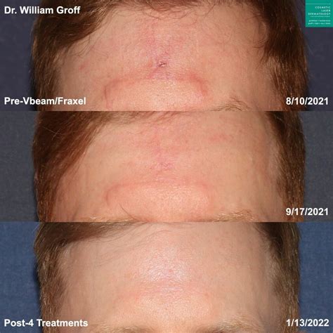 scar acne scar treatment med spa san diego ca clderm