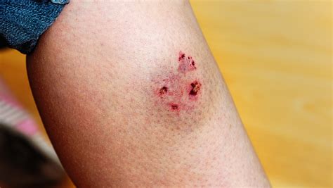 treat  types  wounds australian institute