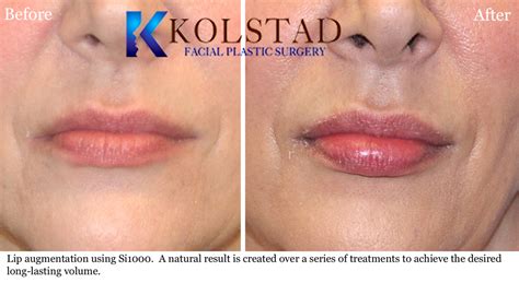 Beautiful and Natural Permanent Lip Augmentation | Dr. Kolstad - San ...