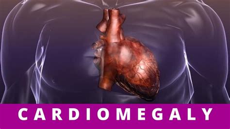 CARDIOMEGALY- what causes cardiomegaly? - YouTube