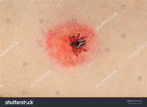 Tick Biting Human Skin Causing Dangerous Stock Photo (Edit Now) 686984089