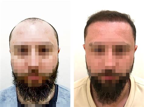 Наши работы по пересадке волос | HairMed, г. Минск