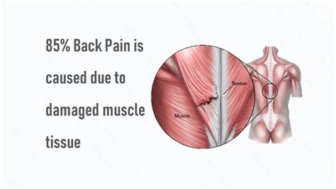 Upper Back Pain Treatment: Symptoms, Causes & Therapy | QI Spine
