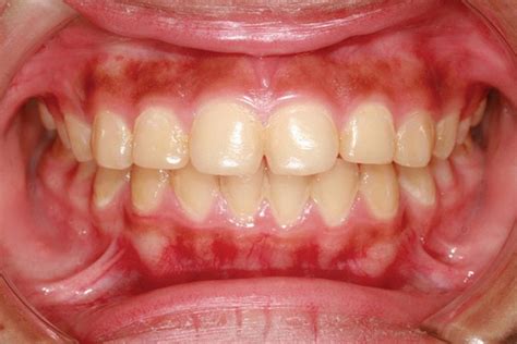 Рак десны: фото, симптомы, признаки, диагностика - Dentist-Club
