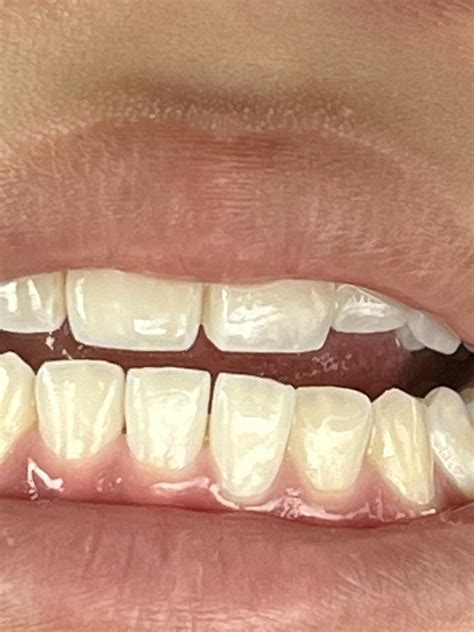Periodontal and subgingival pocket improvement by changing the duration ...