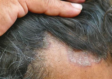 difference  seborrheic dermatitis  scalp psoriasis