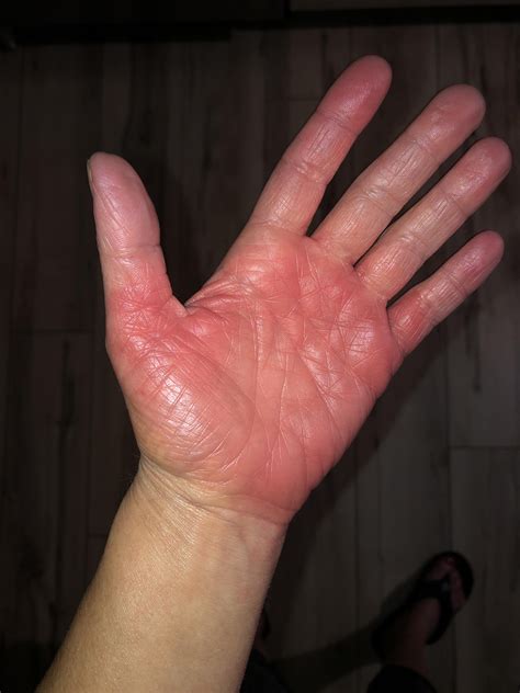 40 best r/erythromelalgia images on Pholder | anyone else’s camera roll