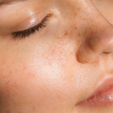 Bum Spots: Why You Get Butt Acne & How To Stop It | Glamour UK