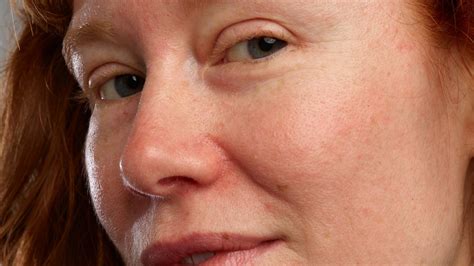 Rosacea + Eye Health: What’s the Connection? | Gladskin