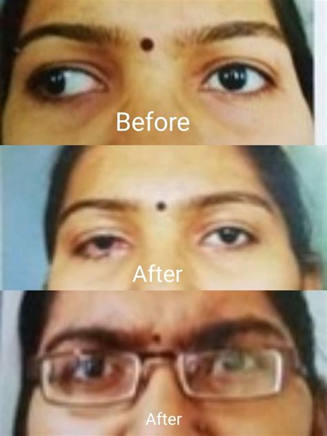 Squint Treatment (Exotropia) | Neo Eye Clinic