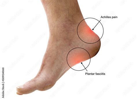 New Runner Heel Pain at Glenn Barbee blog