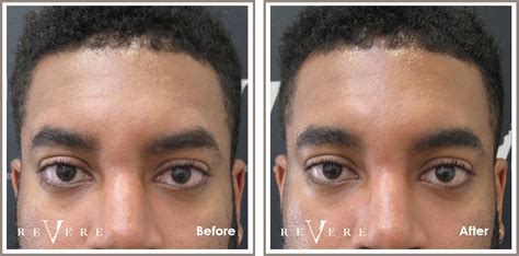 15 Laser Hair Removal Okc Prices Ideas - Stylefer