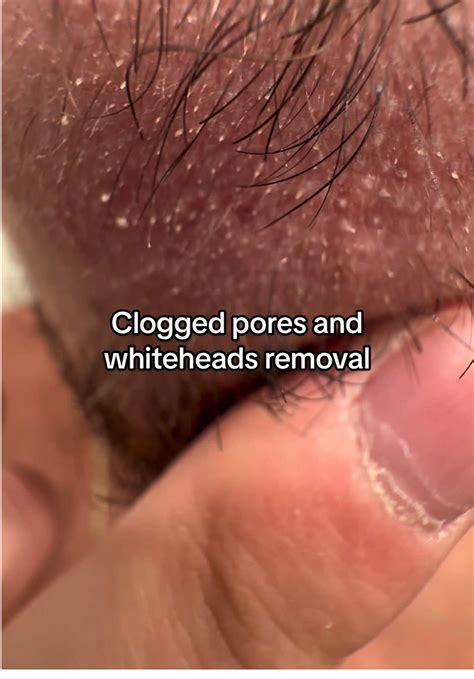 Viewers are mesmerized by the latest extreme blackheads video on TikTok 33