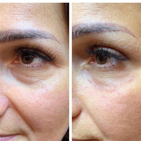 booster injection treatment derma secret mississauga waterloo