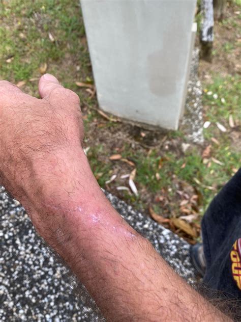 before and after my dad got his BCC removed. : r/medizzy