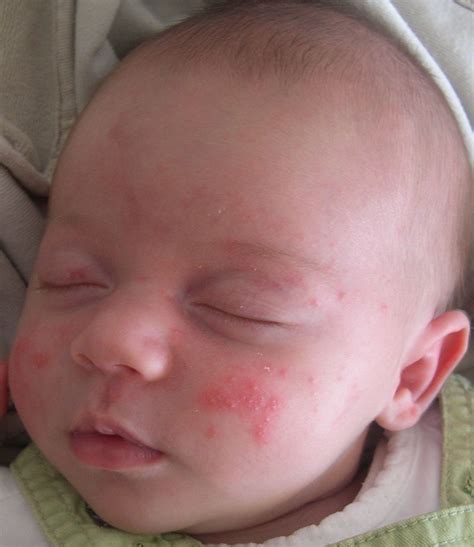 Neonatal Acne - Growing Healthy Together - Long Beach