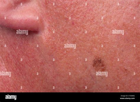 MELANOMA Stock Photo - Alamy