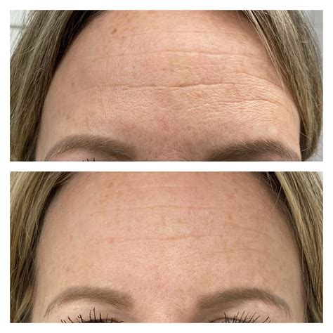 Microneedling Before and After Results - Nikki Butler: Skin Specialist ...