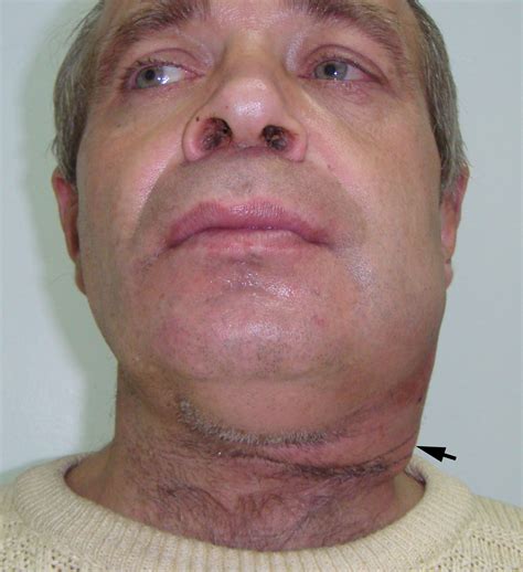 Obstructive Submandibular Sialadenitis Complicated with Severe Neck
