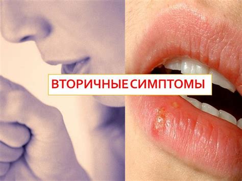 Вич инфекция симптомы у женщин фото