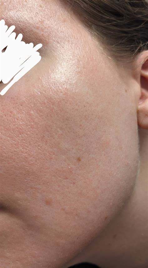 [Routine Help] Constant redness, dry skin, large pores. Any suggestions