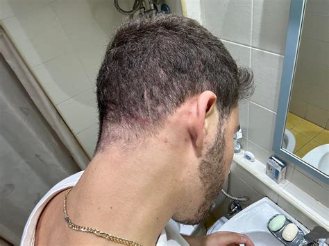 Help, been struggling with folliculitis for the last 6 months, at the